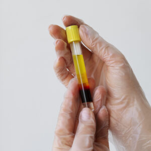 Plasma Rico en Plaquetas (PRP)